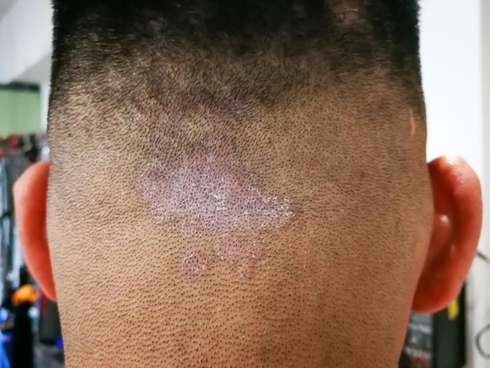 ringworm fungus