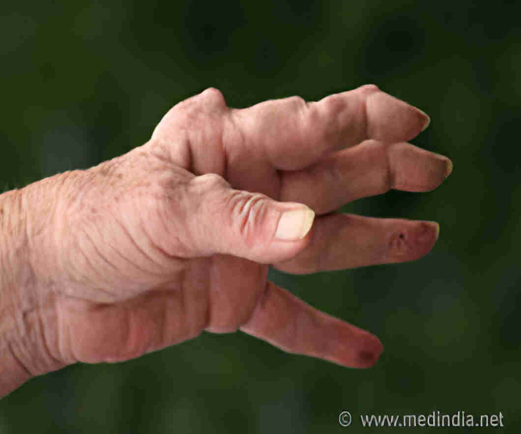 Rheumatoid Arthritis Causes, Symptoms, Types, Treatment & Prevention