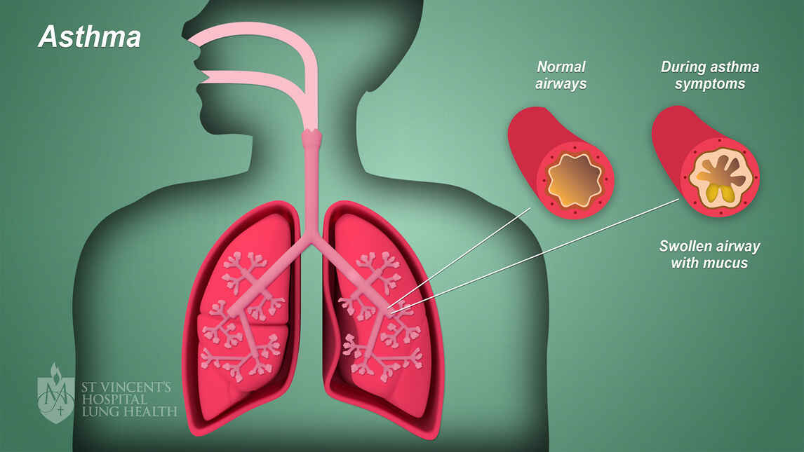 Asthma: Symptoms, Causes, Diagnosis, Treatments & Prevention
