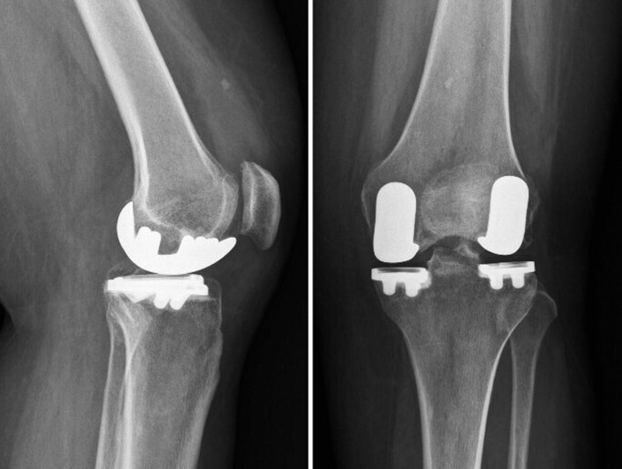 What is Knee Replacement? Types , What to Expect & Cost of Surgery