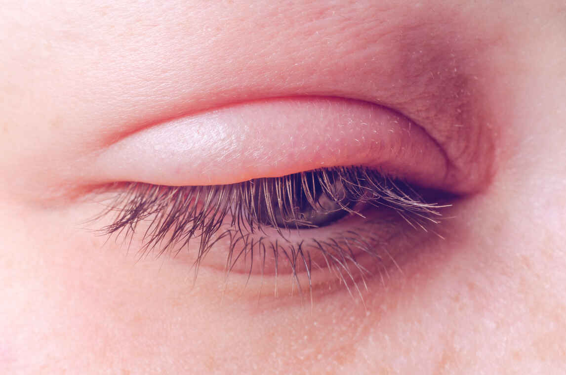 Common Eye Diseases: List of Most Common Eye Diseases in India ...