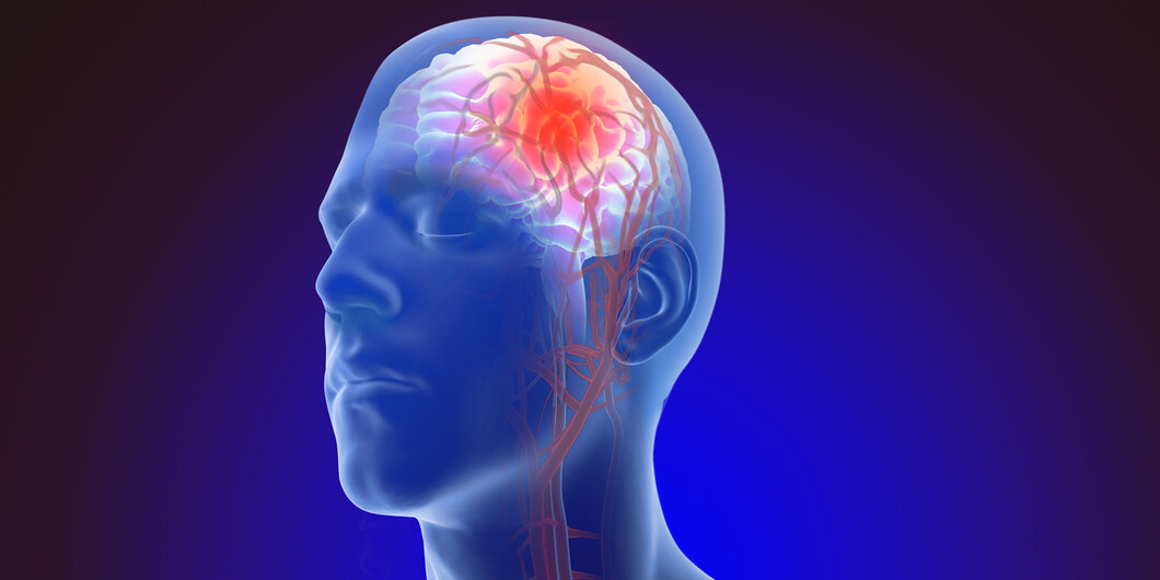 What is brain cerebral aneurysm symptoms causes treatment