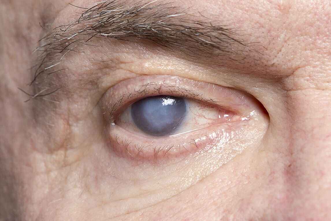 Cataract: What is Cataract Symptoms, Causes, Types, Treatment & Prevention