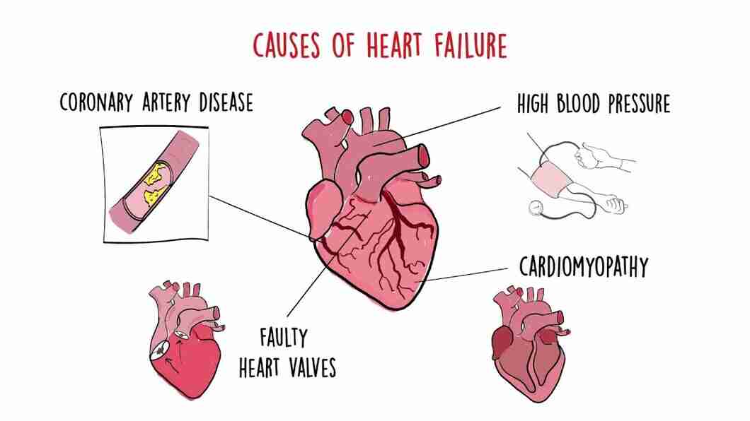 Congestive Heart Failure Symptoms Causes Types Treatment Prevention congestive-heart-failure-symptoms-causes-types-treatment-prevention