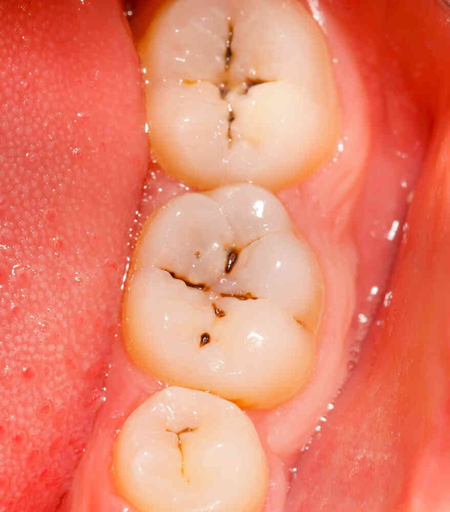 Cavity in molar teeth deals