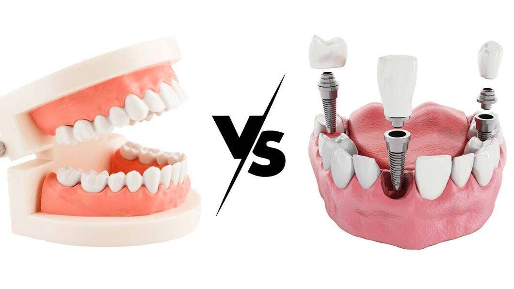 Dental Implants VS Dentures Meaning & Importance