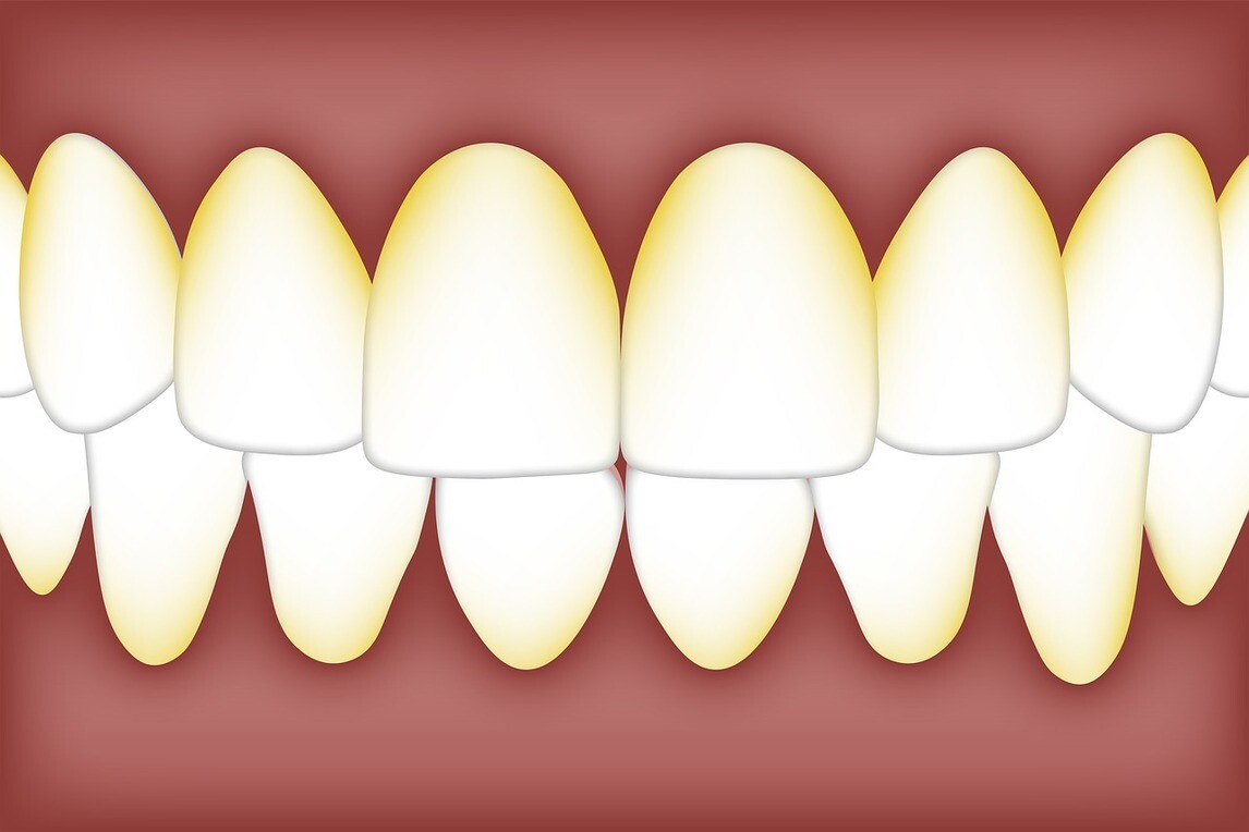 Causes and Treatment of Plaque on Teeth