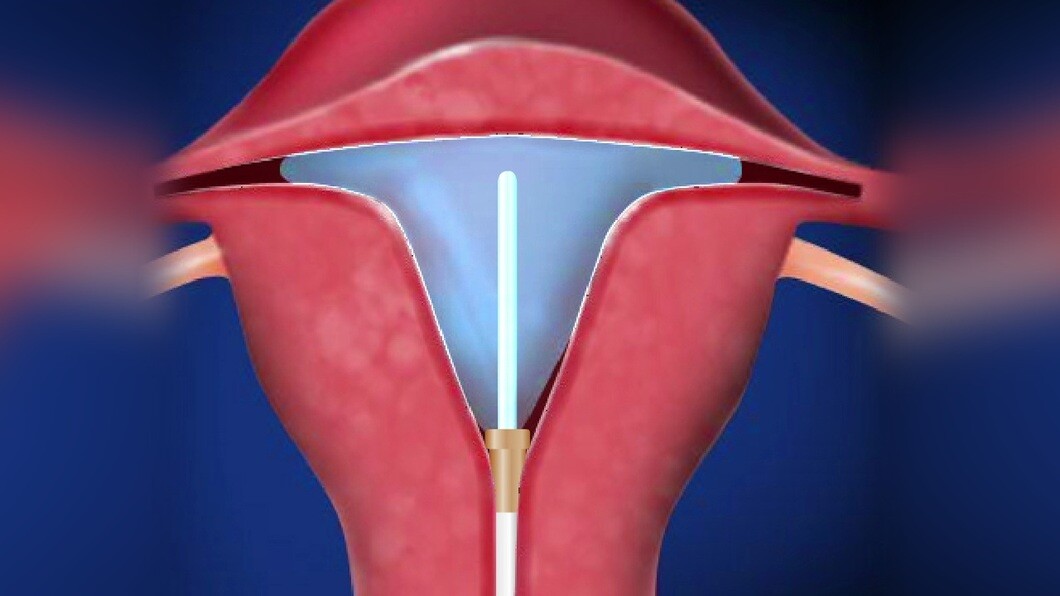 What Is Endometrial Ablation? How Helpful It Is, Everything Explained