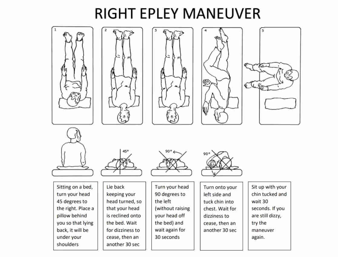 Epley Maneuver Illustration