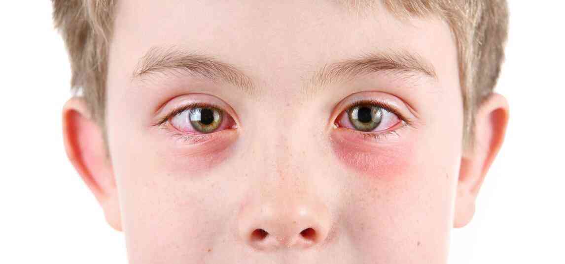 Eye Allergies: Cause, Symptoms, Treatment and Prevention of Eye Allergy