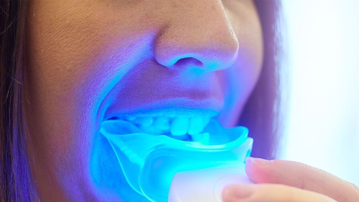 What is UV Teeth Whitening and is it safe?