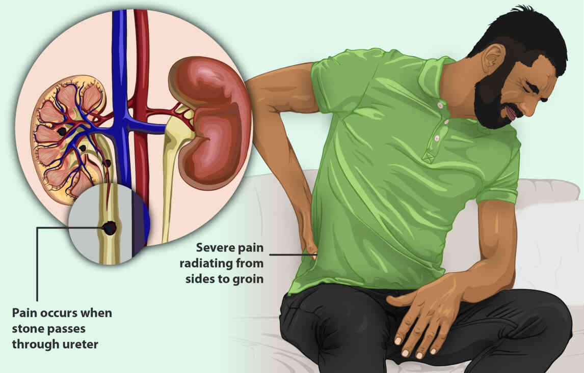 Kidney Stones: Reasons, Symptoms, Causes, Treatment & Prevention