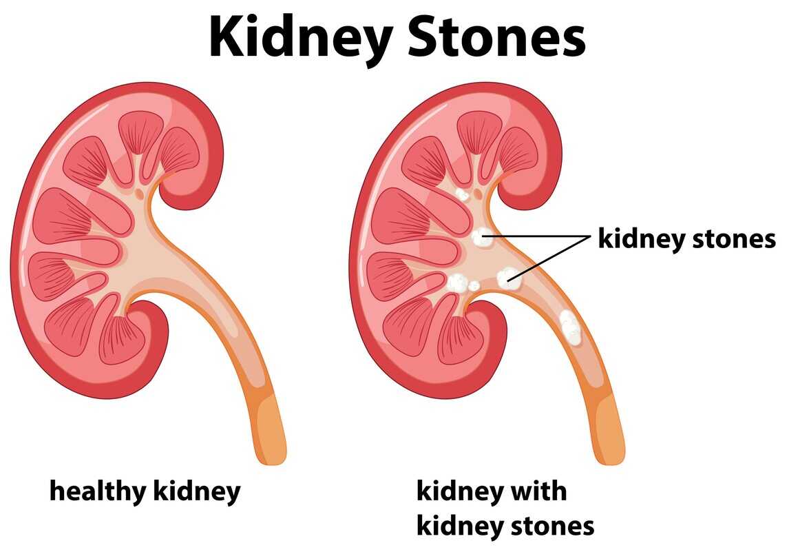 Kidney Stones: Reasons, Symptoms, Causes, Treatment & Prevention