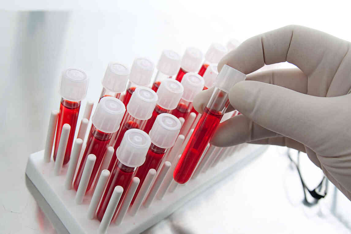 LDH Blood Test What is LDH Test? Purpose, Procedure & Results