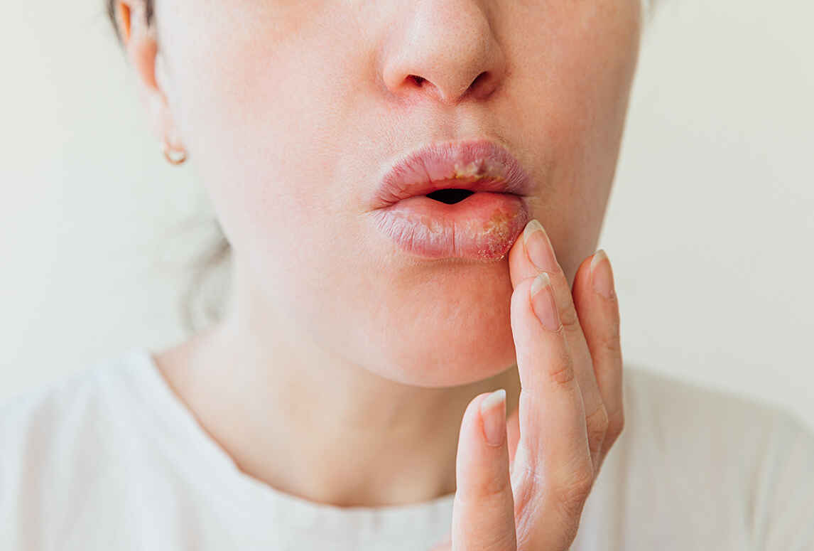 Lip Allergy Cause Symptoms Treatment And Prevention Of Lip Allergy