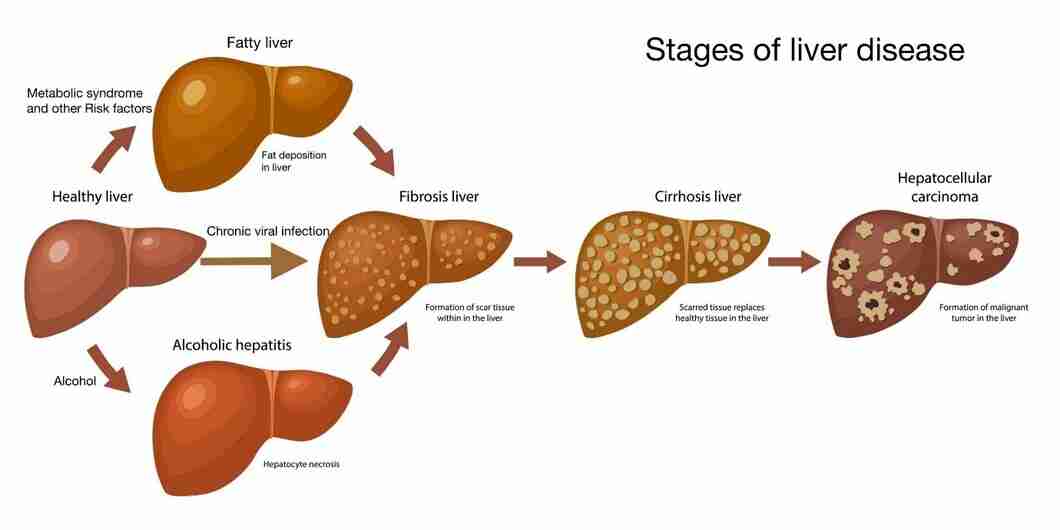 Liver Cirrhosis Causes Symptoms Treatment And Prevention Gma | My XXX ...