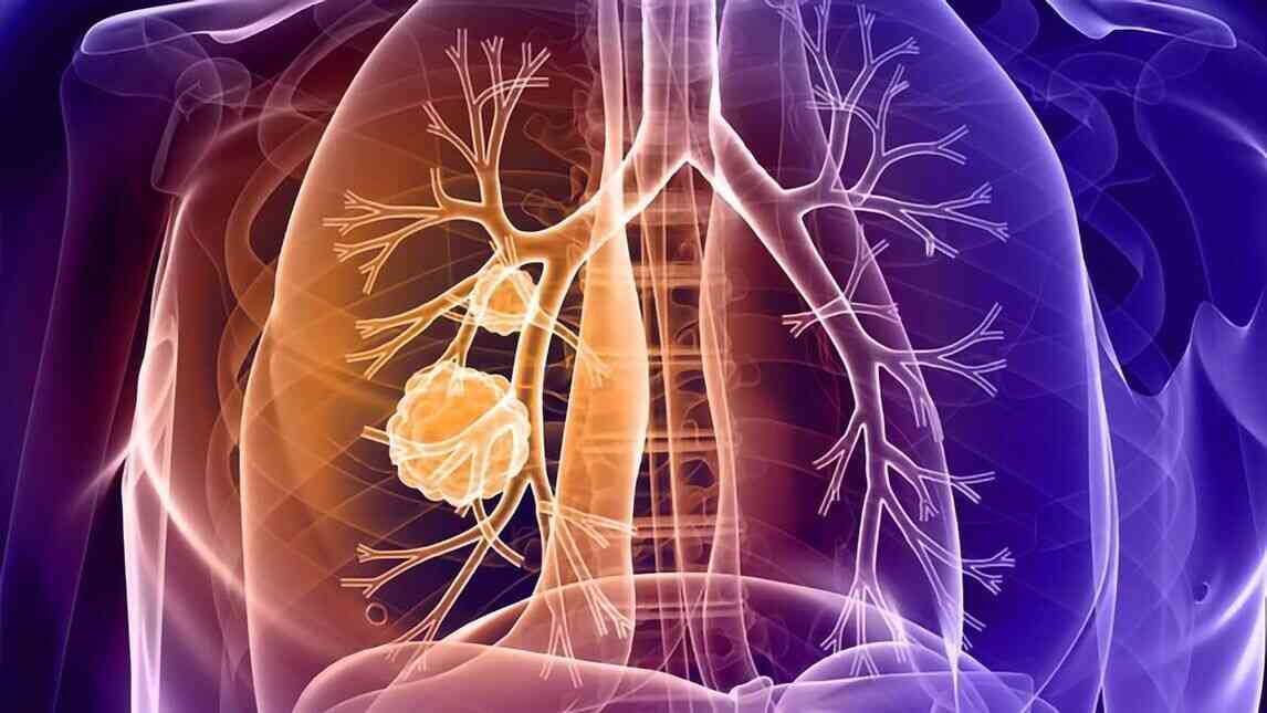 Lung Tumor Causes, Types, Symptoms, Diagnosis and Treatment