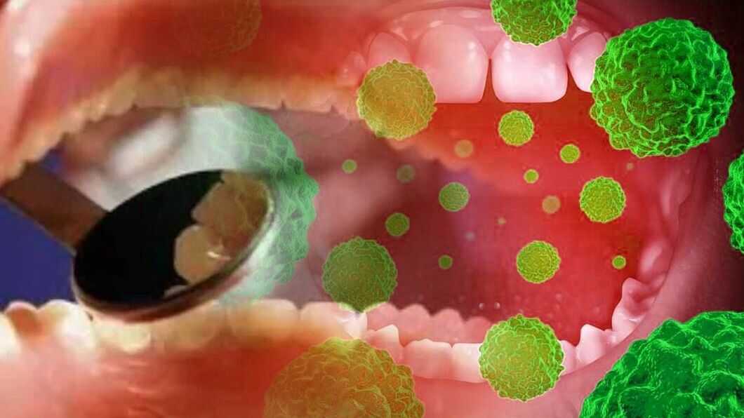 oral cancer