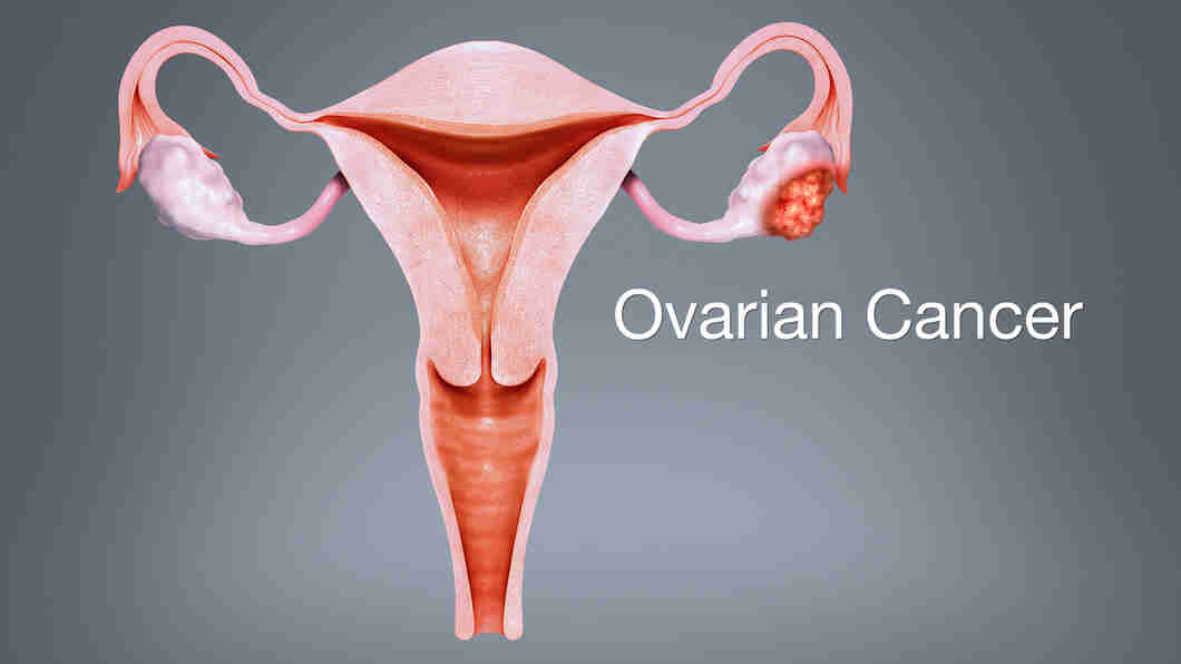 Ovarian Cancer Causes, Types, Symptoms, Diagnosis and Treatment