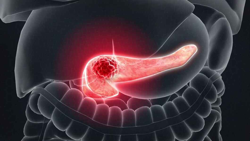 Pancreatic cancer causes types symptoms and treatment