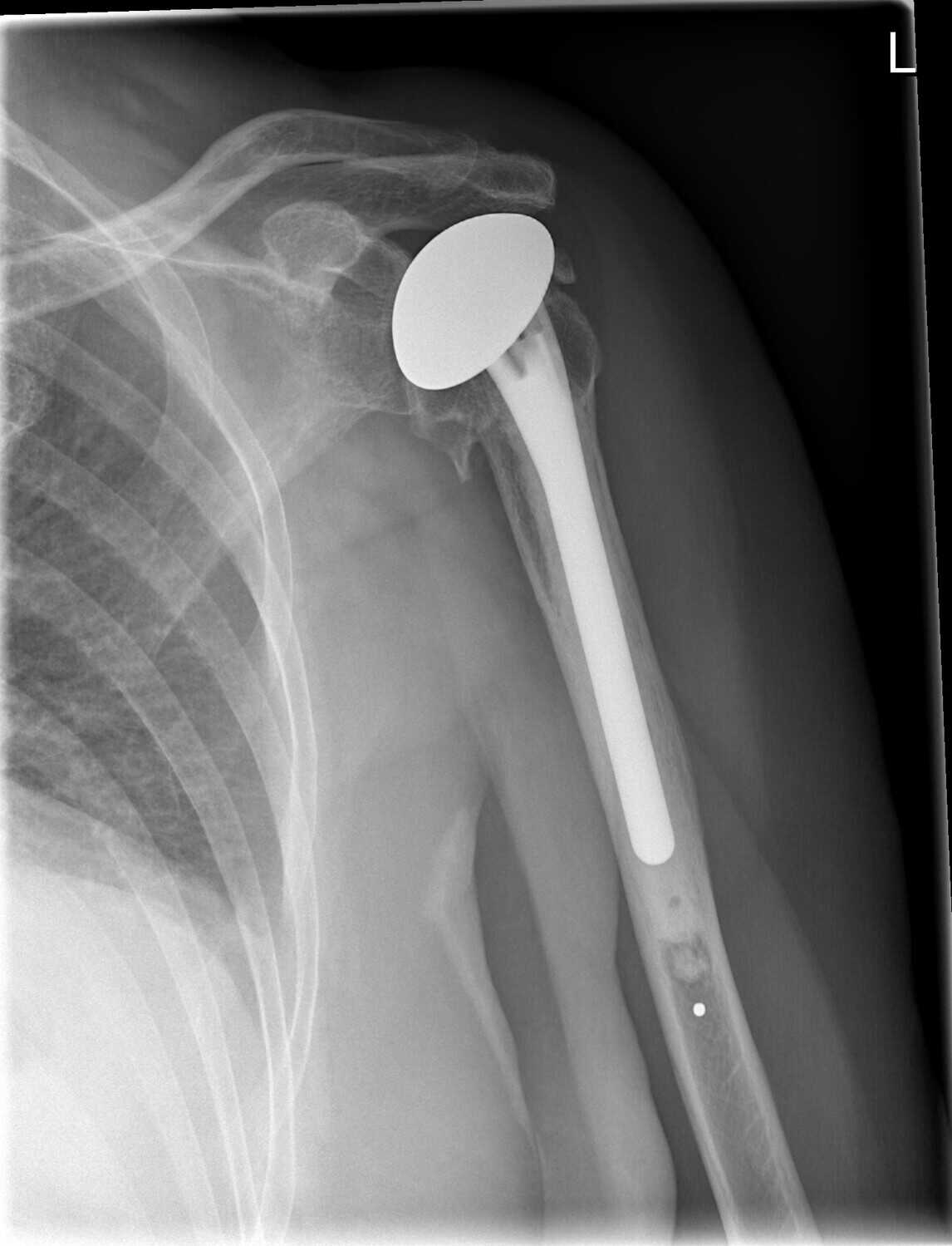 Shoulder Replacement Surgery Types, How Helpful It Is, Risks & Cost