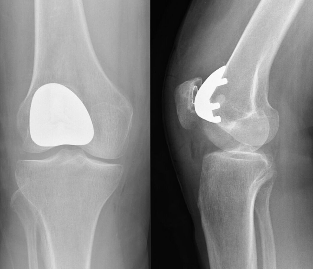 What is Knee Replacement? Types , What to Expect & Cost of Surgery