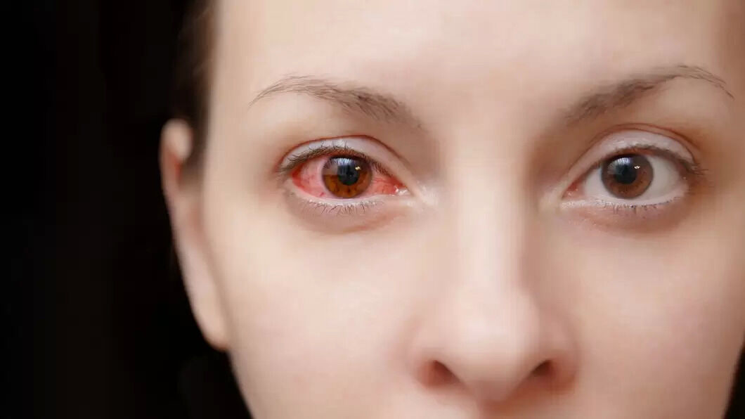 Pink Eye Disease Symptoms, Causes and Treatment