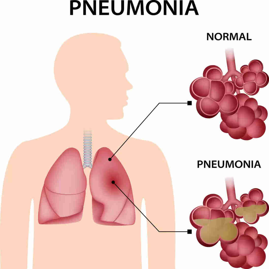 Pneumonia Vaccine Purpose, Dosage & Side Effects