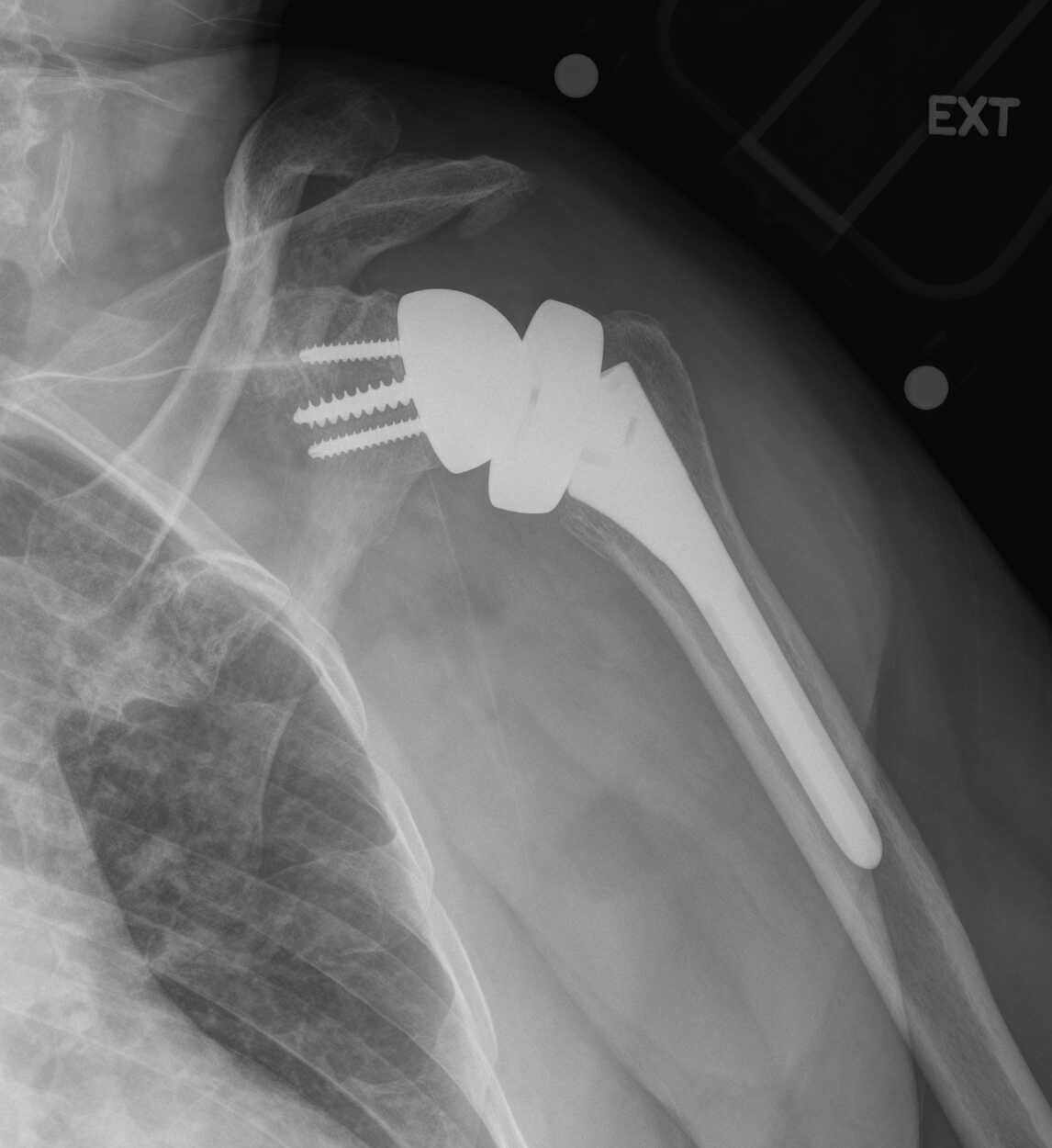 Shoulder Replacement Surgery Types, How Helpful It Is, Risks & Cost