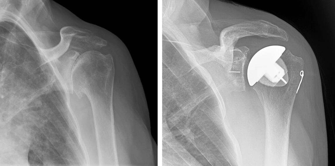 Shoulder Replacement Surgery Types, How Helpful It Is, Risks & Cost
