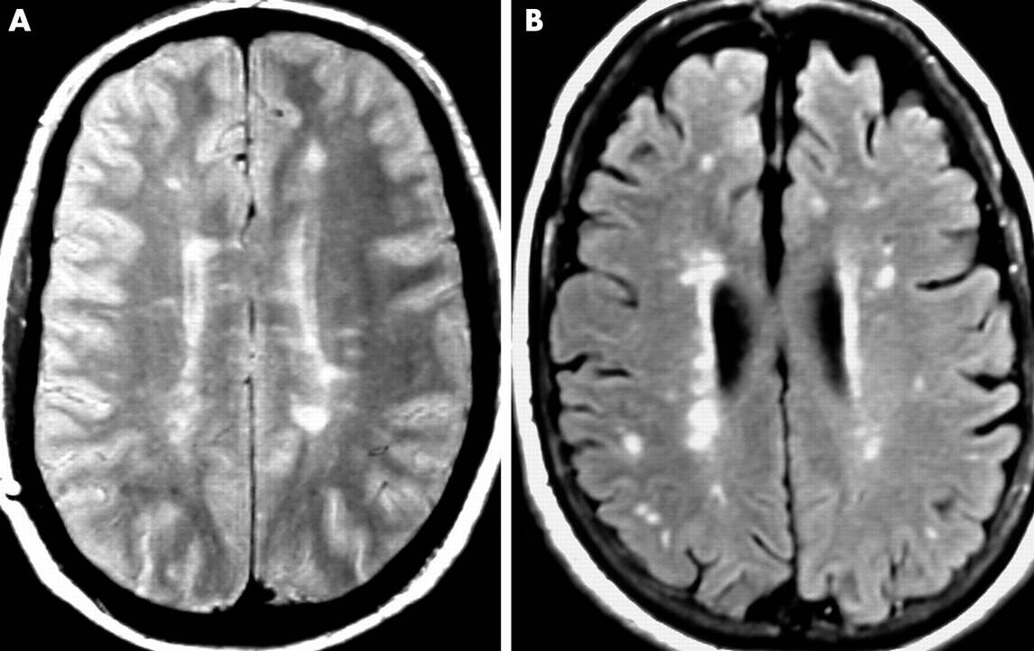 What is Wet Brain Causes, Symptoms, Diagnosis and Treatment