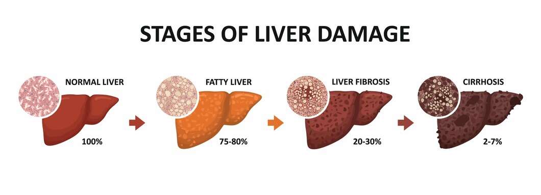 Alcohol Related Liver Disease Types Treatments alcohol-related-liver-disease-types-treatments