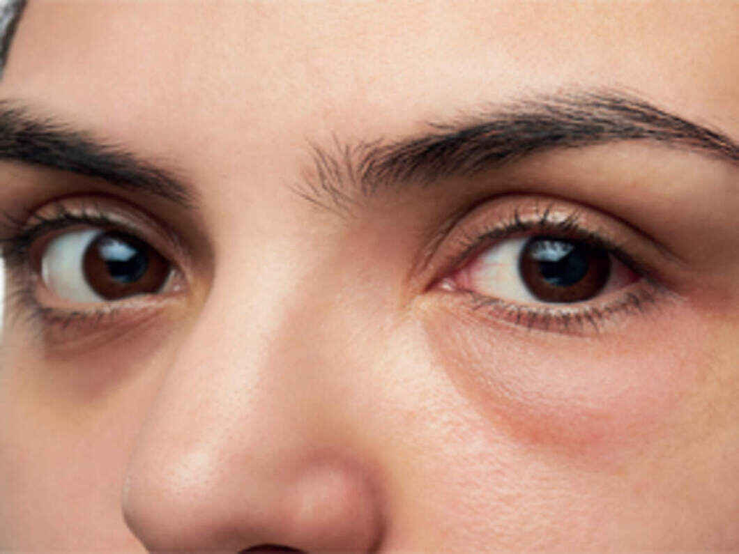 Causes, Symptoms and Treatments For Puffy Eyes