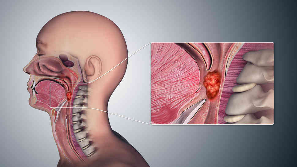 Throat Cancer Causes Symptoms Diagnosis Treatment And Prevention 