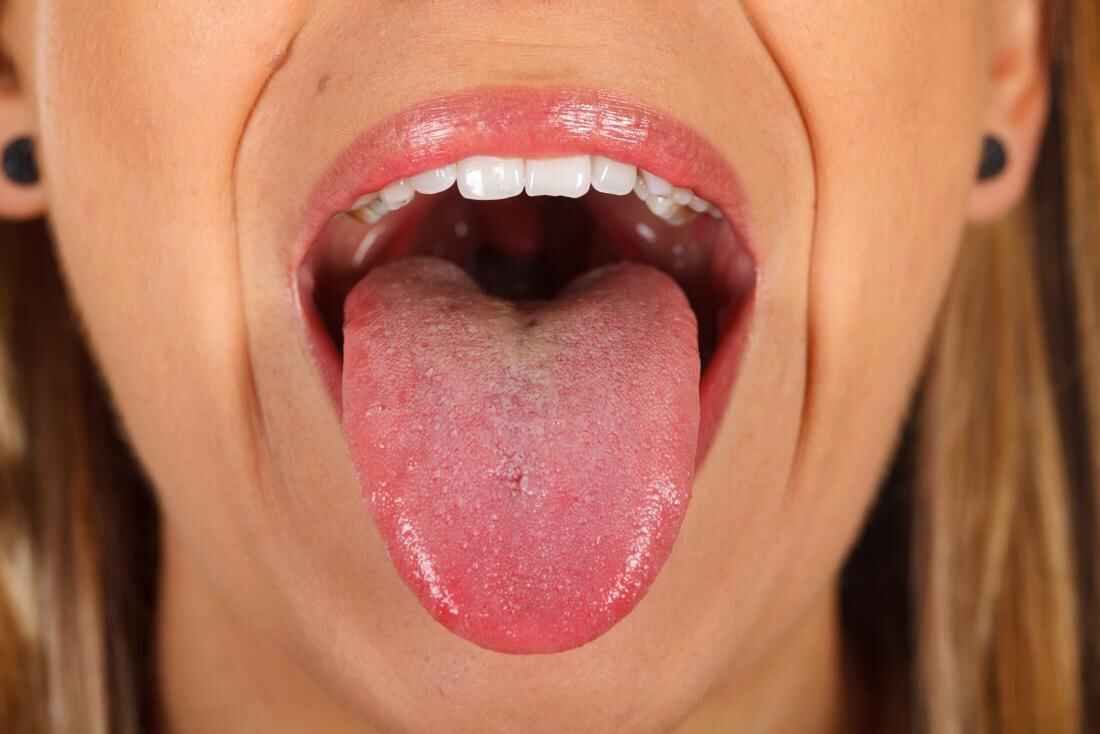 tongue cancer presentation