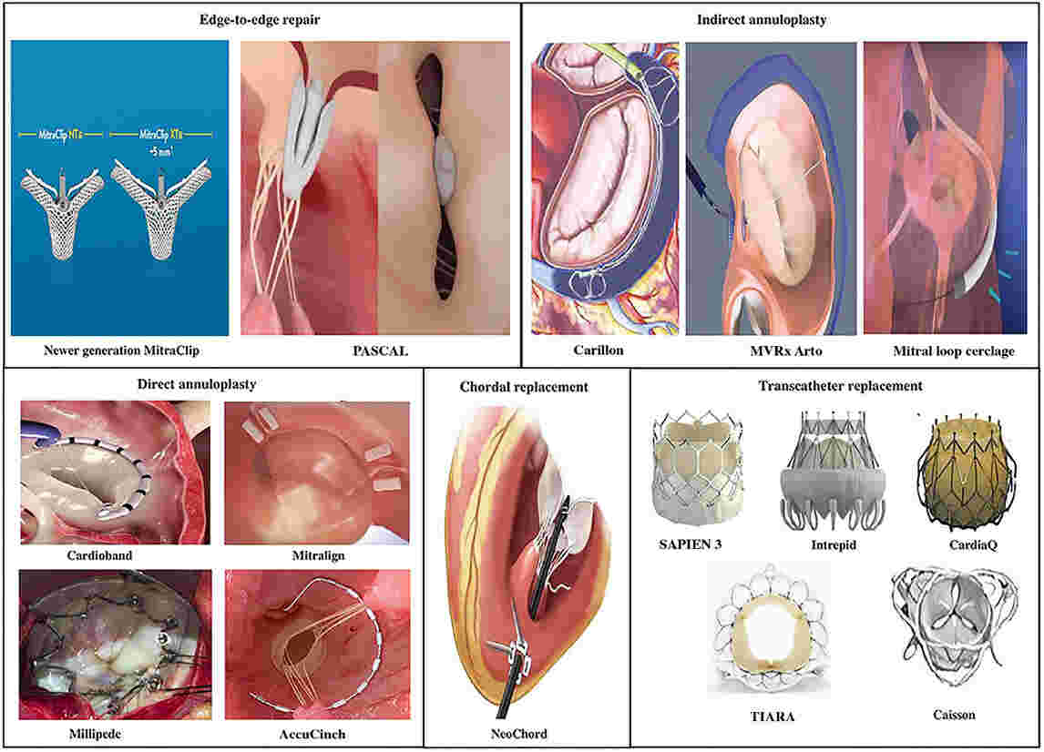 What is Heart Valve Surgery Meaning and Different Types