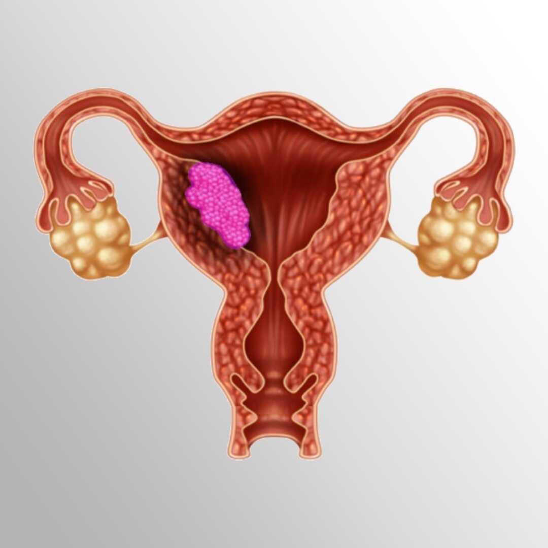 different types of uterine cancer