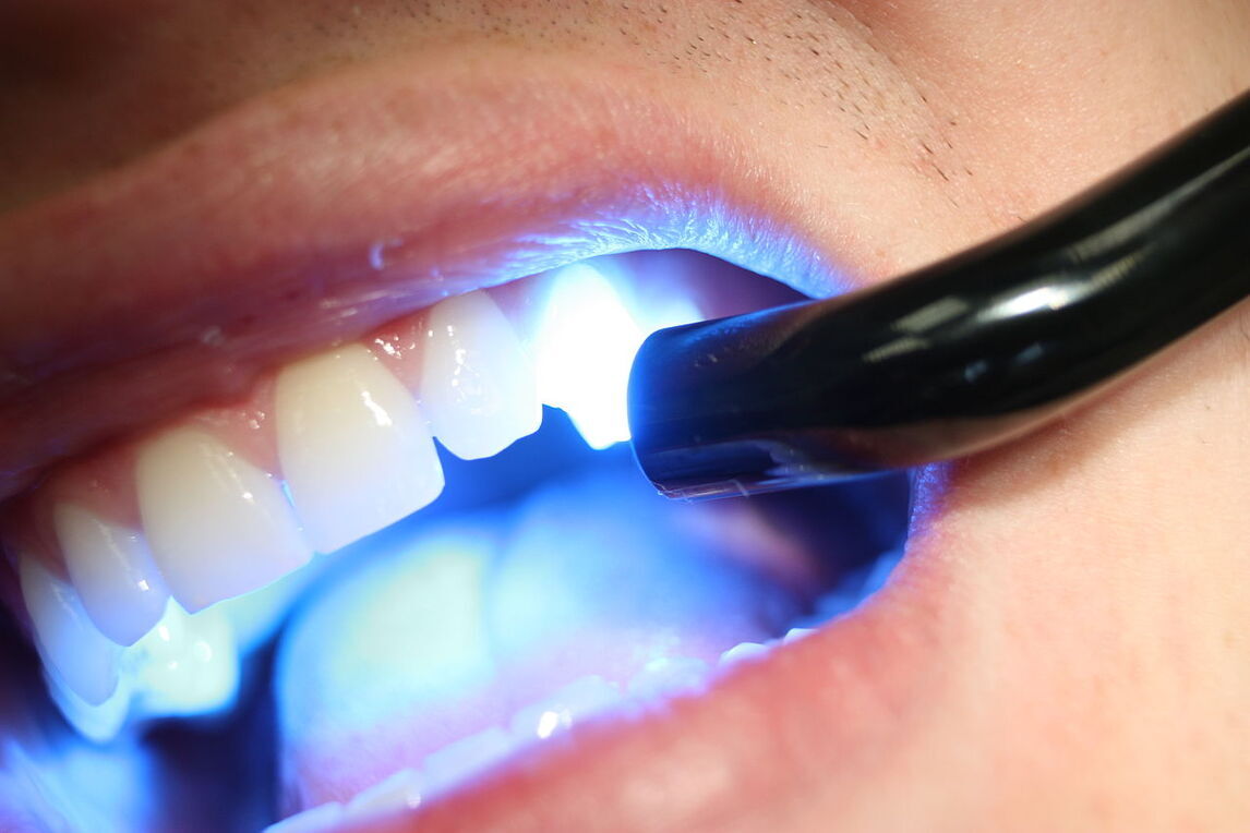 What is UV Teeth Whitening and is it safe?