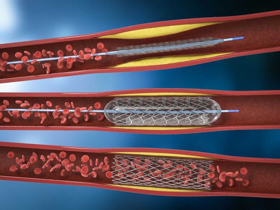 Angioplasty surgery Meaning, Types, How Helpful It Is & Cost
