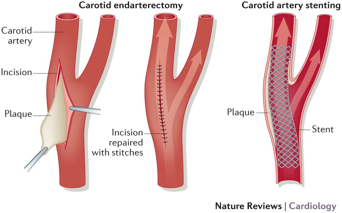 Эверсионная каротидная эндартерэктомия