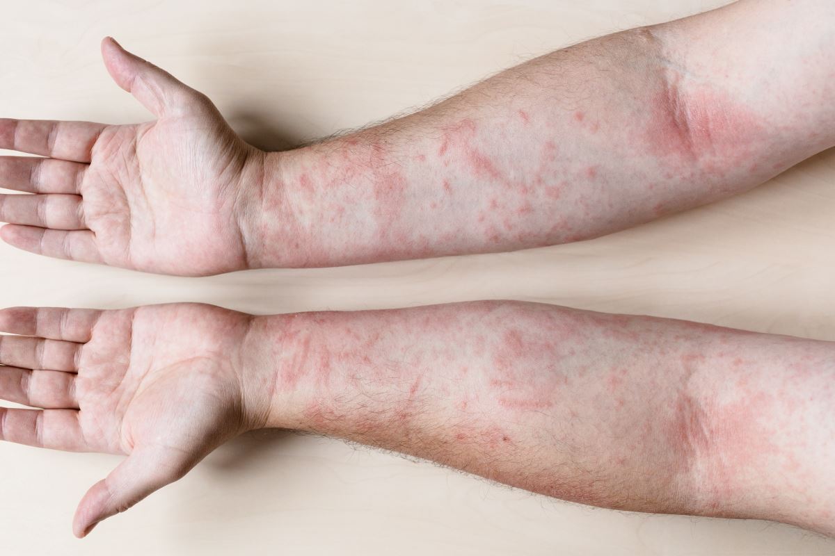 keratosis pilaris