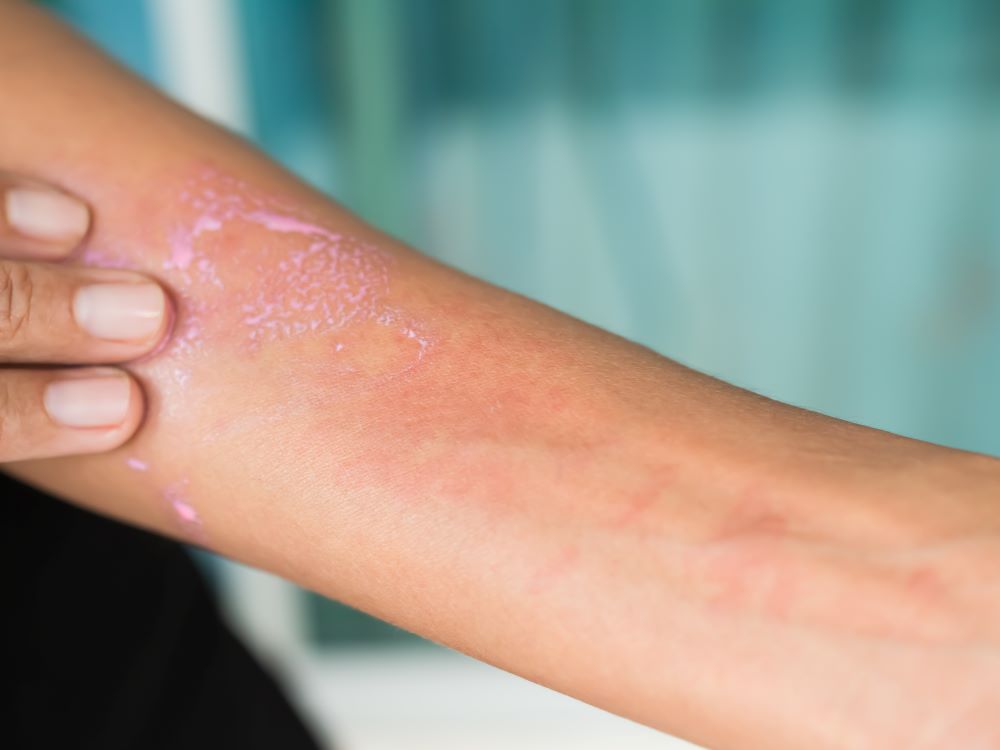urticaria-on-hand-woman