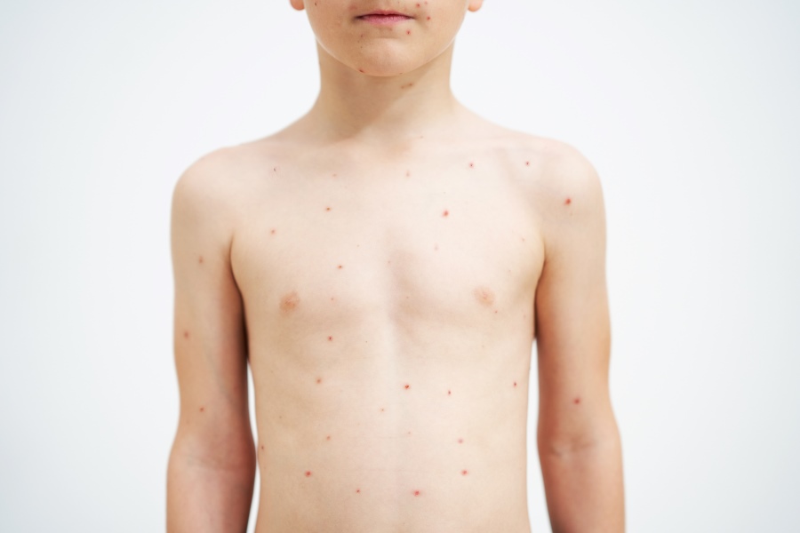 what to eat and avoid during chicken pox